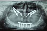 impianto-denti-poco-osso